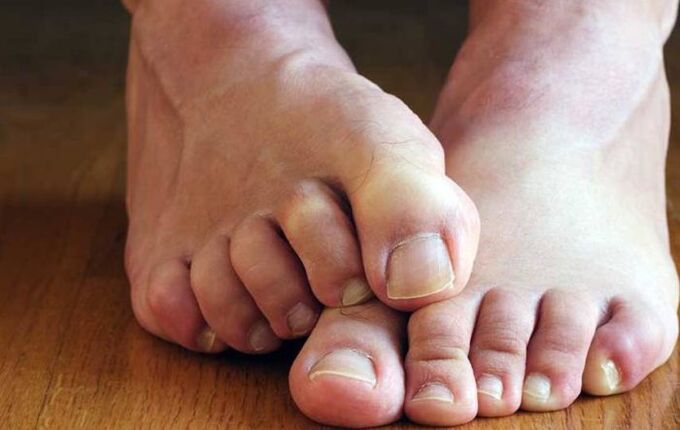ayaklarda skuamöz mantar semptomları