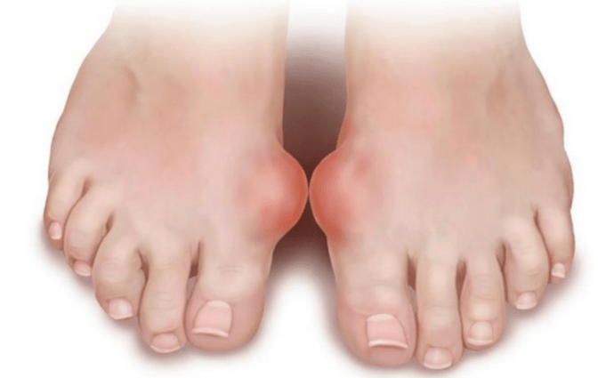 bacaklarda mantar oluşumunun nedeni olarak ayağın deformitesi