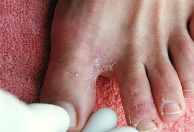 ayak parmakları arasında mantar semptomları