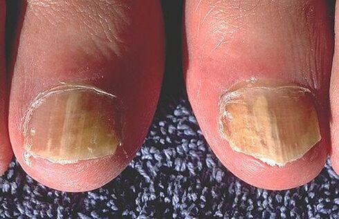 Dermatofitlerden etkilenen tırnaklar